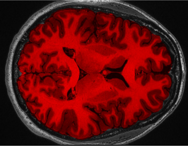 Software for building a three-dimensional image of the brain from MRI scans was developed at NSTU-NETI